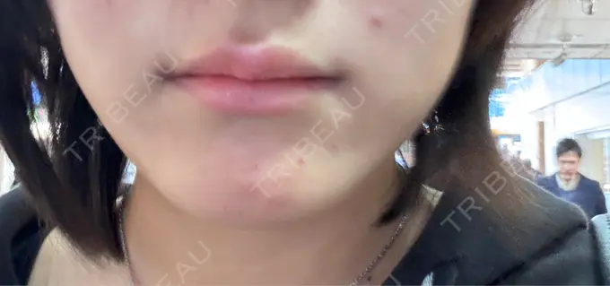 ボトックス（あご） / ボトックス（口角） / シワ取りボトックス LE CLINIC DAY 0 メイン用