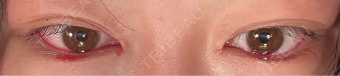 クマ治療 / 下まぶたの脂肪取り APOLLO BEAUTY CLINIC AFTER メイン用