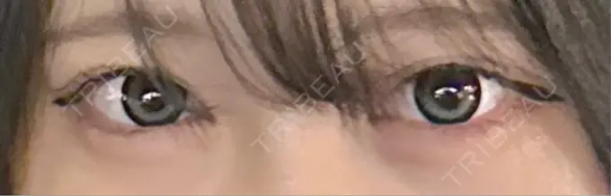 クマ治療 / 下まぶたの脂肪取り APOLLO BEAUTY CLINIC DAY 7 メイン用