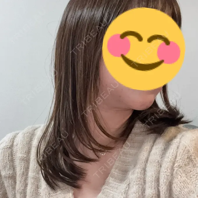 糸リフト / 脂肪吸引注射（顔） APスキンクリニック銀座 DAY 42 メイン用