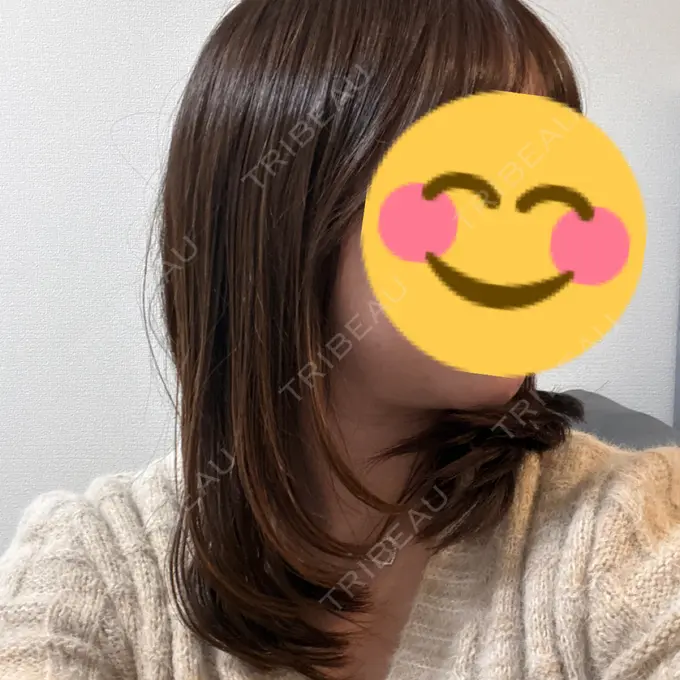 糸リフト / 脂肪吸引注射（顔） APスキンクリニック銀座 DAY 42 メイン用