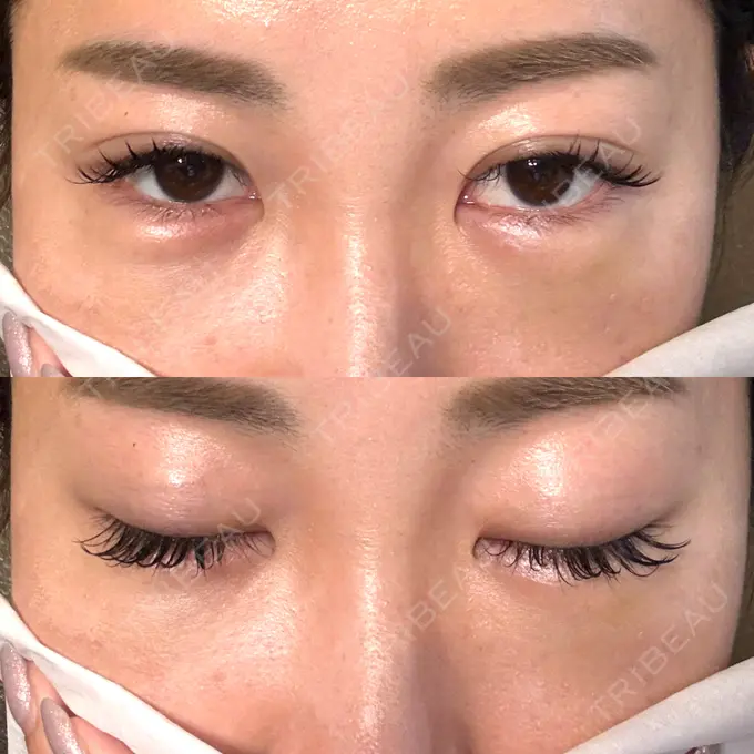 クマ治療 / 脂肪注入（目の下） / その他（口元） 湘南美容クリニック 千葉センシティ院 DAY 6 メイン用