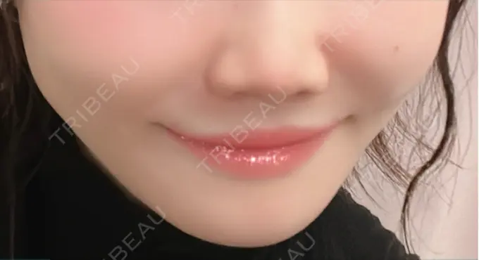 ヒアルロン酸注入（鼻翼基部） ルラ美容クリニック 仙台院 / ルラスキンクリニック 仙台院 DAY 2 メイン用