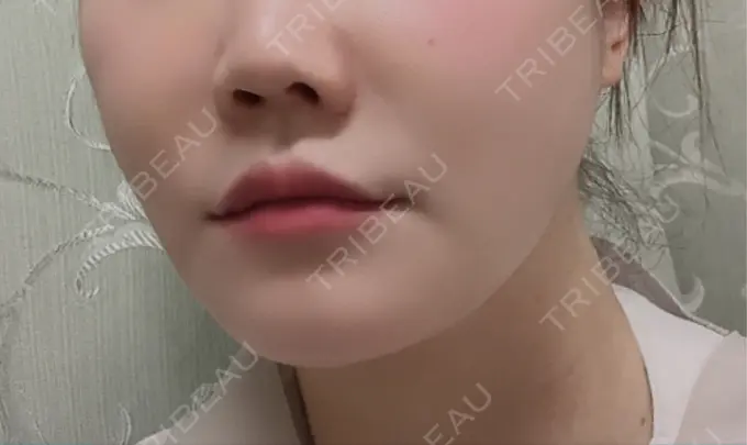 ヒアルロン酸注入（鼻翼基部） ルラ美容クリニック 仙台院 / ルラスキンクリニック 仙台院 AFTER メイン用