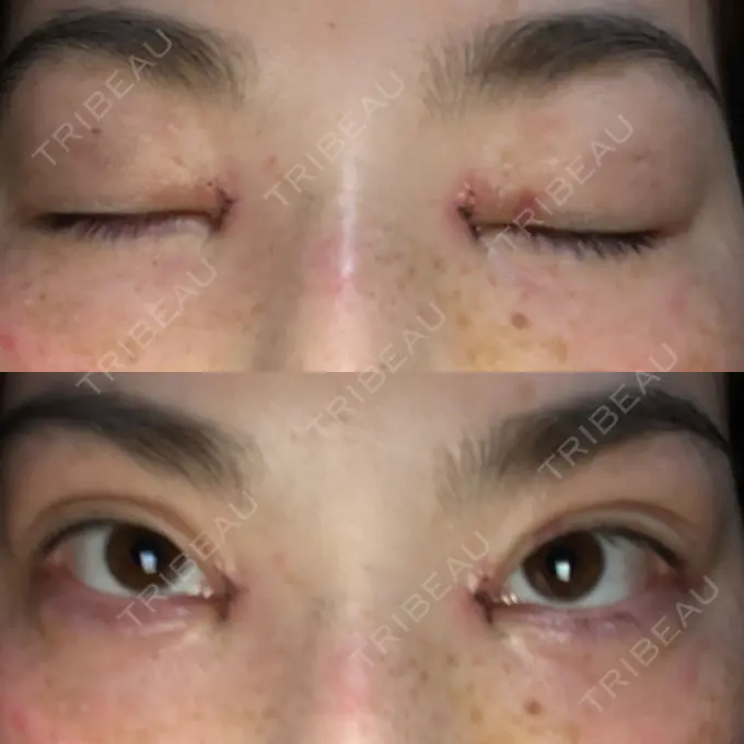 目頭切開 湘南美容クリニック 橋本院 DAY 3 メイン用