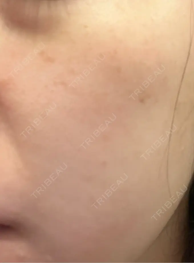 イオン導入 / ピーリング（ハリ・ツヤ） / ルメッカ ルラ美容クリニック 千葉院 / ルラスキンクリニック 千葉院 AFTER メイン用