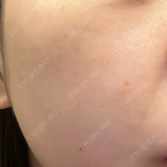 イオン導入 / ピーリング（ハリ・ツヤ） / ルメッカ ルラ美容クリニック 千葉院 / ルラスキンクリニック 千葉院 DAY 8 メイン用