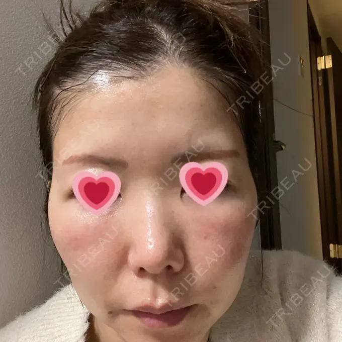 肌育注射（ジュベルックなど） BAO CLINIC 梅田院 DAY 0 メイン用