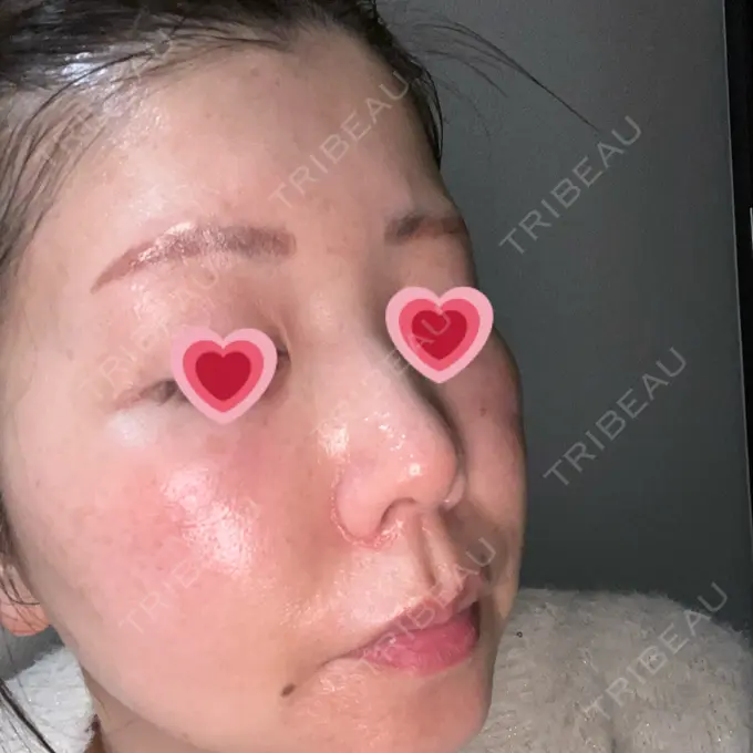 肌育注射（ジュベルックなど） BAO CLINIC 梅田院 DAY 0 メイン用