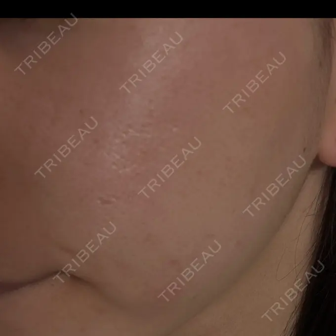 ピーリング（ニキビ・毛穴） 大美会クリニック 梅田院 AFTER メイン用