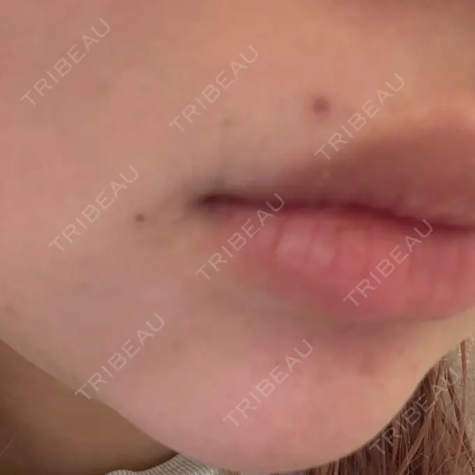 ほくろ・いぼ切除（肌） R Beauty CLINIC 名古屋院 DAY 10 メイン用