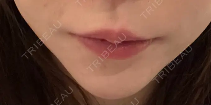 ボトックス（あご） 湘南美容クリニック 名古屋院 DAY 7 メイン用