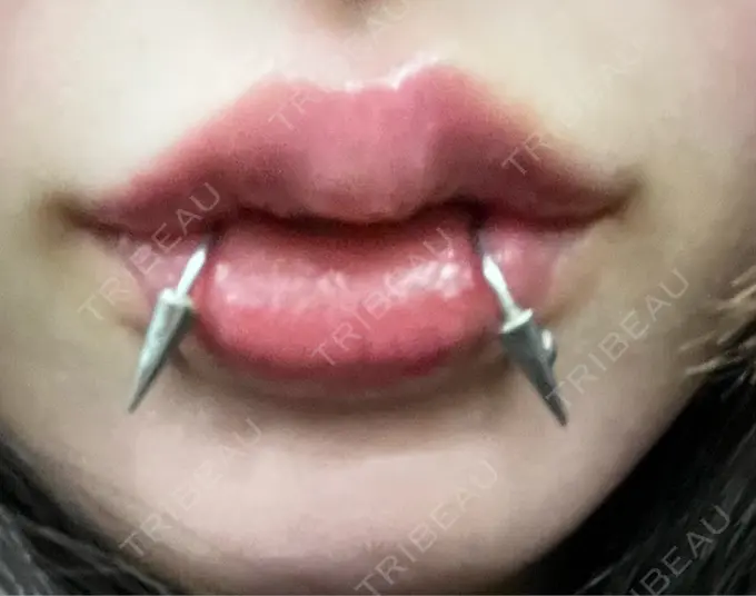 ヒアルロン酸注入（唇） / ボトックス（口角） ルラ美容クリニック 大阪本院 DAY 11 メイン用