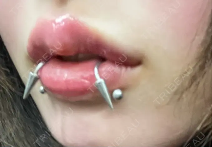 ヒアルロン酸注入（唇） / ボトックス（口角） ルラ美容クリニック 大阪本院 DAY 11 メイン用