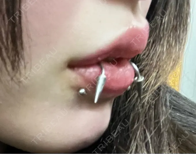 ヒアルロン酸注入（唇） / ボトックス（口角） ルラ美容クリニック 大阪本院 DAY 11 メイン用