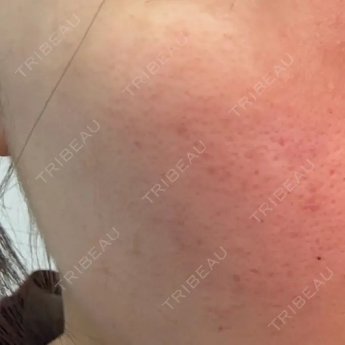 肌育注射（ジュベルックなど） メディアージュクリニック 青山院 DAY 0 メイン用