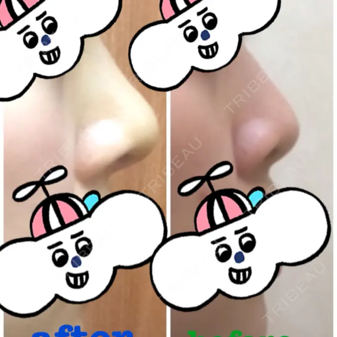 鼻尖形成（切開） / 軟骨移植 白山クリニック 大分 DAY 5 メイン用