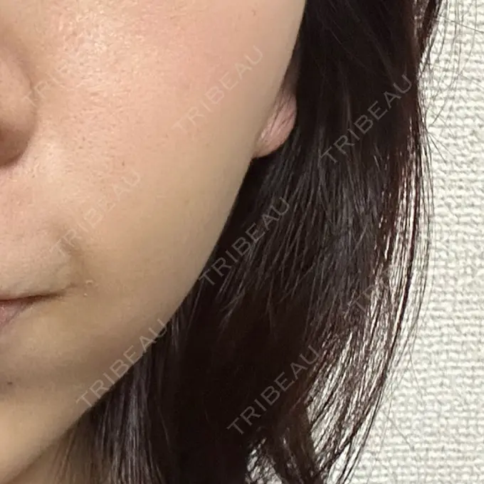 ボトックス（あご） / ボトックス（エラ・小顔） 湘南美容クリニック 横浜院 DAY 0 メイン用