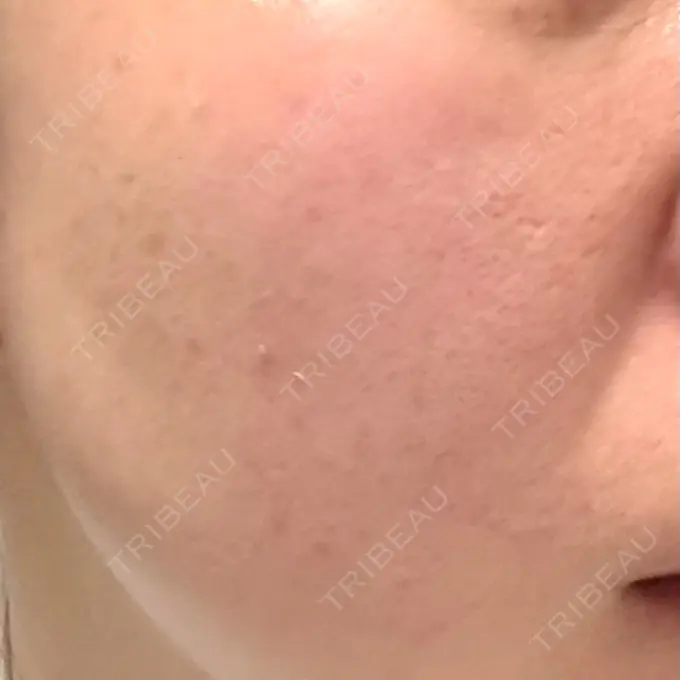 光治療（フォトフェイシャルなど） 仙台TAクリニック DAY 0 メイン用