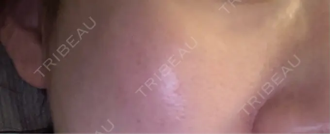 肌育注射（ジュベルックなど） メディアージュクリニック 青山院 DAY 14 メイン用