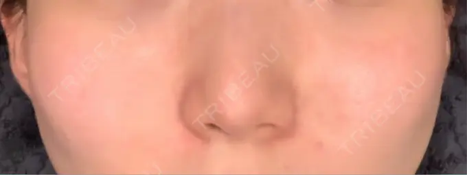 肌育注射（ジュベルックなど） メディアージュクリニック 青山院 AFTER メイン用