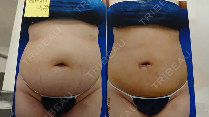 脂肪吸引（お腹） 城本クリニック 岡山院 DAY 10 メイン用