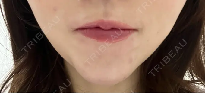 ボトックス（あご） 湘南美容クリニック 名古屋院 DAY 8 メイン用