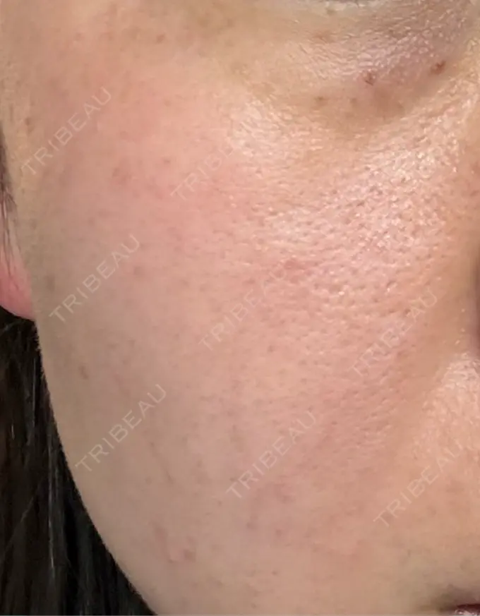 光治療（フォトフェイシャルなど） 仙台TAクリニック DAY 1 メイン用