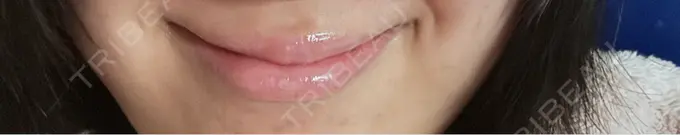 ボトックス（あご） / ボトックス（口角） / シワ取りボトックス LE CLINIC AFTER メイン用