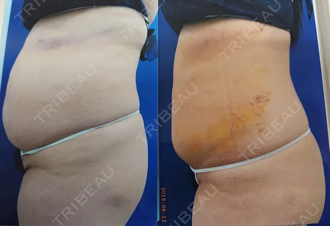 脂肪吸引（お腹） 城本クリニック 岡山院 DAY 10 メイン用