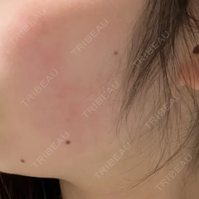 インモード 東京美容皮膚科アロエクリニック池袋 DAY 11 メイン用