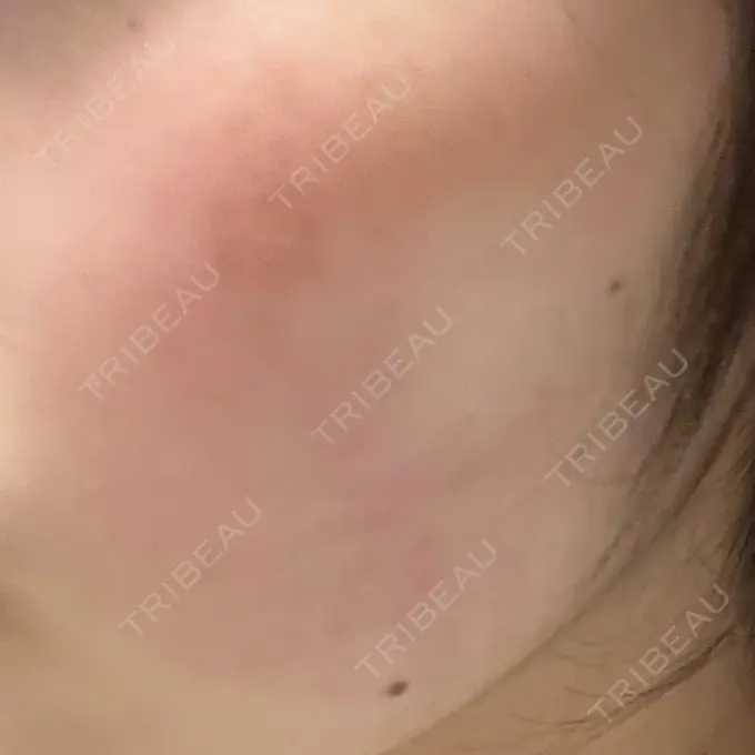 インモード 東京美容皮膚科アロエクリニック池袋 DAY 9 メイン用