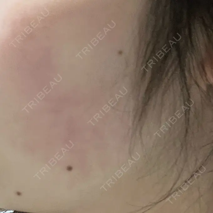 インモード 東京美容皮膚科アロエクリニック池袋 DAY 8 メイン用