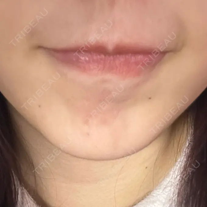 ボトックス（あご） / ボトックス（エラ・小顔） 湘南美容クリニック 横浜院 DAY 1 メイン用