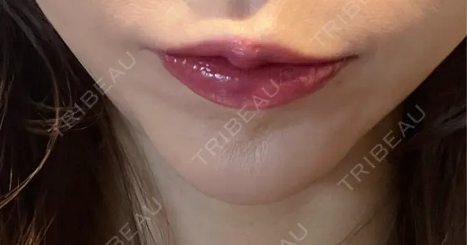 ボトックス（あご） 湘南美容クリニック 名古屋院 DAY 9 メイン用