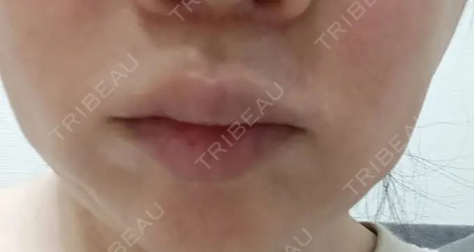 肌ヒアルロン酸注入（たるみ・シワ改善） / ヒアルロン酸注入（唇） AZ BEAUTY CLINIC AFTER メイン用