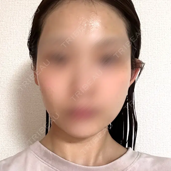 ボルニューマ ルラ美容クリニック 札幌大通り院 AFTER メイン用