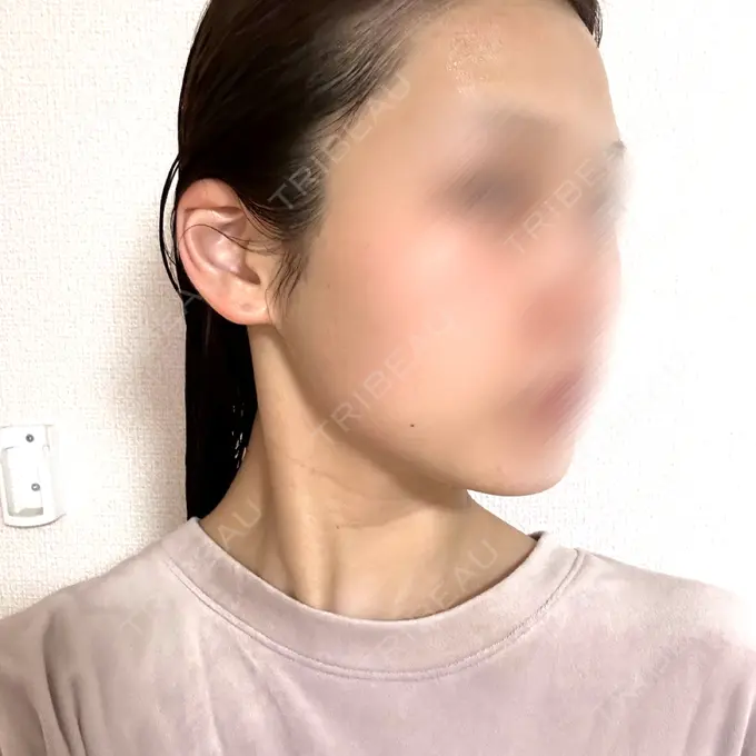 ボルニューマ ルラ美容クリニック 札幌大通り院 DAY 0 メイン用