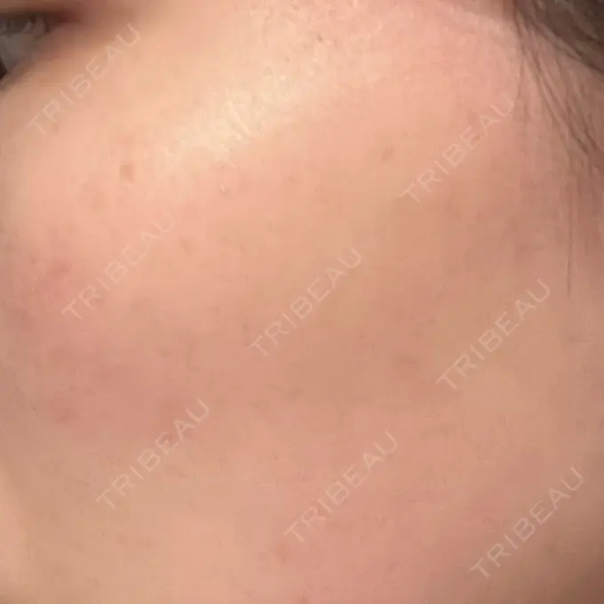 ピコレーザートーニング（美白・肝斑） おおかみ美容のクリニック 横浜院 AFTER メイン用