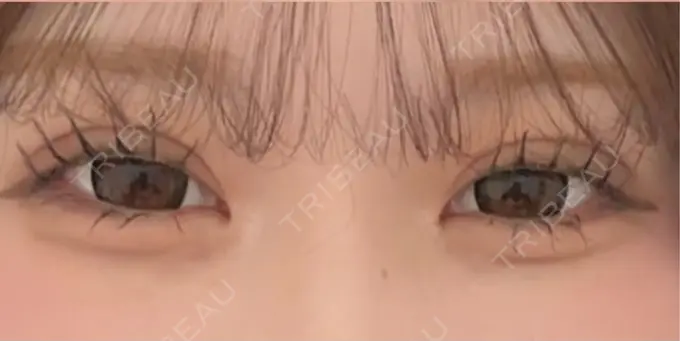 二重埋没 / 上まぶたの脂肪取り アリエル美容クリニック 水戸院 DAY 21 メイン用