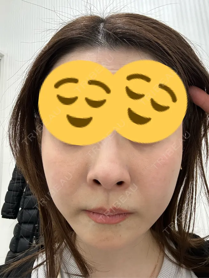 ボトックス（あご） / ボトックス（エラ・小顔） TCB東京中央美容外科 三島院 DAY 2 メイン用