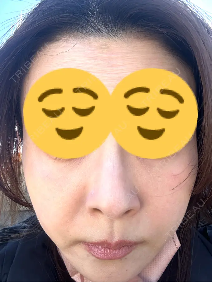 ボトックス（あご） / ボトックス（エラ・小顔） TCB東京中央美容外科 三島院 DAY 3 メイン用