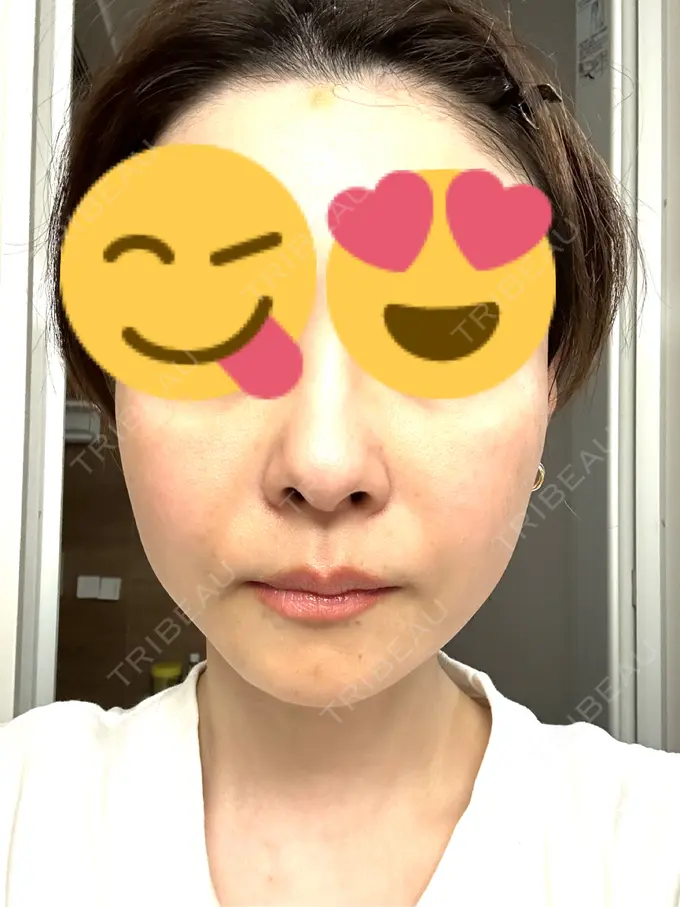 ボトックス（あご） / ボトックス（エラ・小顔） TCB東京中央美容外科 三島院 DAY 4 メイン用