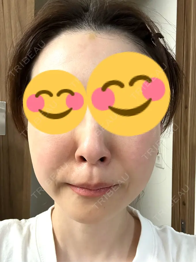 ボトックス（あご） / ボトックス（エラ・小顔） TCB東京中央美容外科 三島院 DAY 5 メイン用