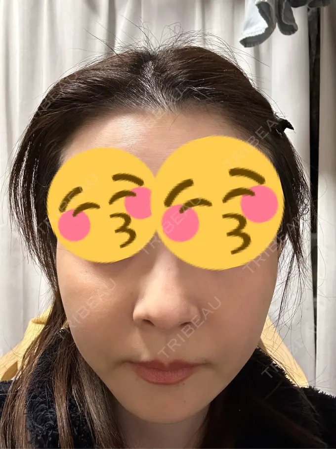 ボトックス（あご） / ボトックス（エラ・小顔） TCB東京中央美容外科 三島院 DAY 6 メイン用