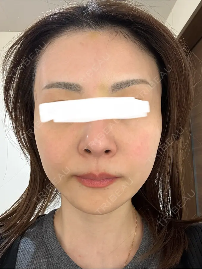 ボトックス（あご） / ボトックス（エラ・小顔） TCB東京中央美容外科 三島院 DAY 7 メイン用