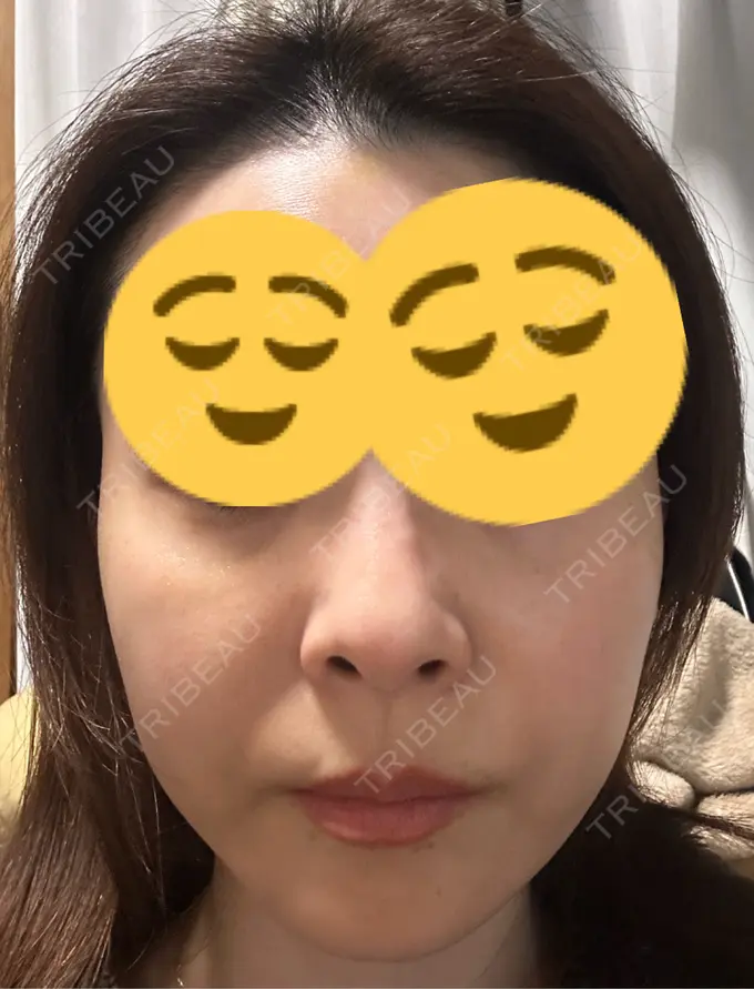 ボトックス（あご） / ボトックス（エラ・小顔） TCB東京中央美容外科 三島院 DAY 8 メイン用