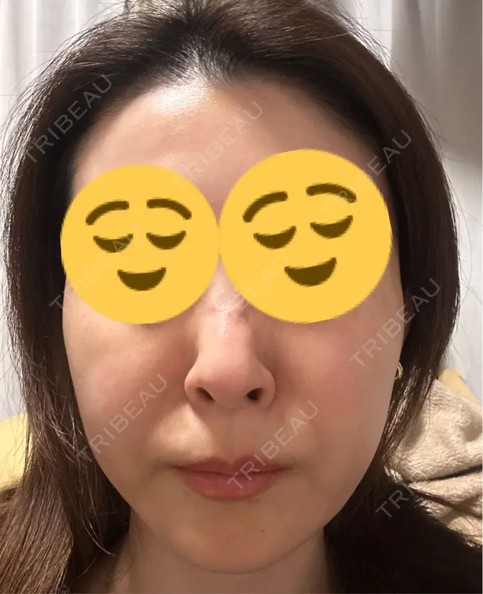 ボトックス（あご） / ボトックス（エラ・小顔） TCB東京中央美容外科 三島院 DAY 9 メイン用