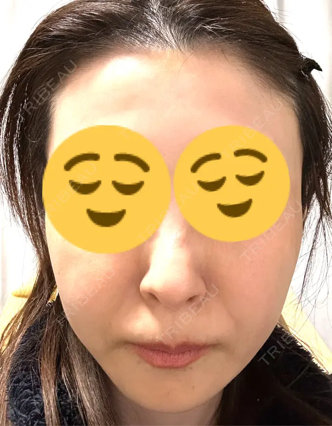 ボトックス（あご） / ボトックス（エラ・小顔） TCB東京中央美容外科 三島院 AFTER メイン用