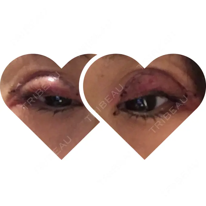 眼瞼下垂（切開） ブリスクリニック形成外科・美容外科・美容皮膚科 福岡 DAY 1 メイン用